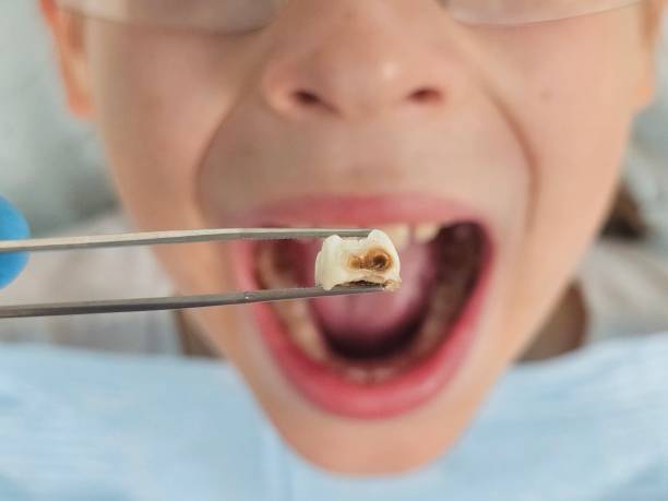 Best Root Canal Emergency Dentist  in Parole, MD
